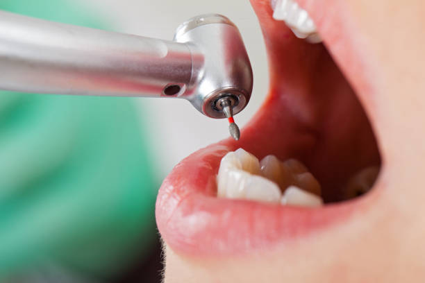 Best Emergency Wisdom Teeth Removal in Huntland, TN